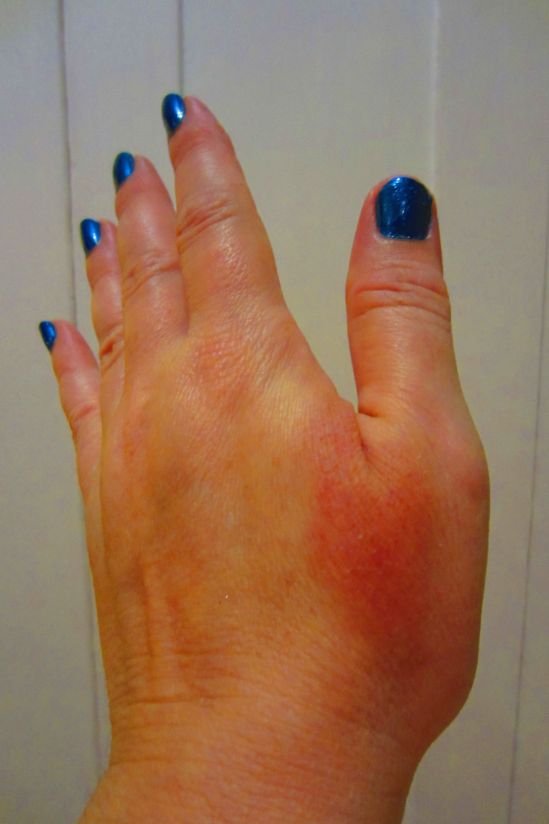 Even so, it's not all glamor being me! This weekend, I smashed my thumbnail below the nail line, necessitating the cutting of my nails. TRAUMA! I also steamed the crap out of my thumb, during which moment my one thought was, "Shit, I will NEVER do this to an entire lobster!"